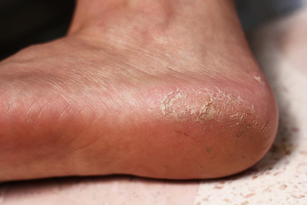 Calluses  El Paso, TX 